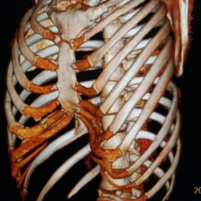 3D reconstruction showing significant anterior chest wall deformity