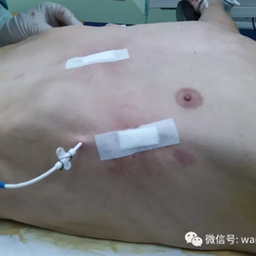 The deformity was completely resolved after the surgery