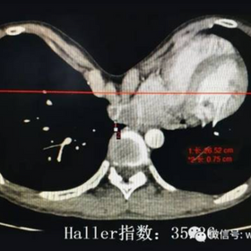 Typical CT image of pectus excavatum