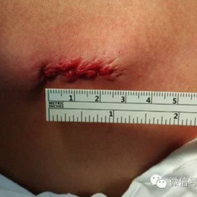 The surgical incisions are 2.5cm long