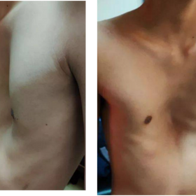 The patient's chest wall exhibited a deep valley-like appearance before the surgery.