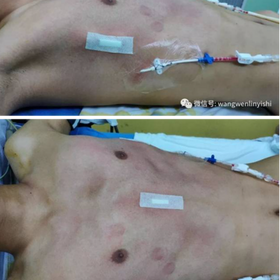 The deformity disappeared after the surgery, restoring the normal appearance of the chest wall.