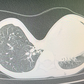 CT examination shows a severe depression of the anterior chest wall, causing significant compression of the heart, which is completely displaced to the left chest cavity.