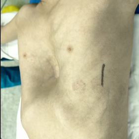 The chest depression resembles a "funnel" shape