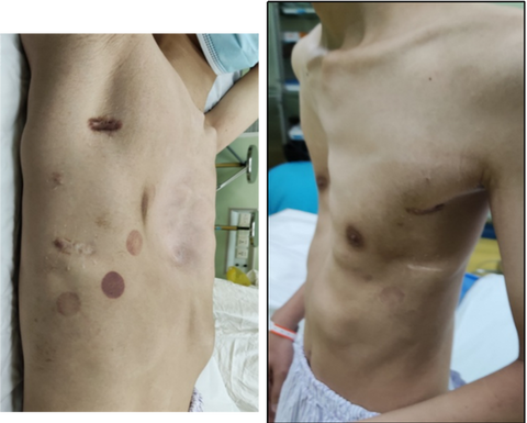 Preoperative appearance of the chest wall showing severe and asymmetrical depression in the center with multiple surgical scars on the sides.