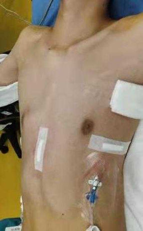 The chest wall basically returned to its normal shape after surgery.