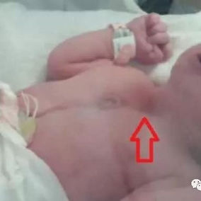 The chest wall of a newborn shows a depression in the mid-upper chest, which becomes more noticeable during inhalation