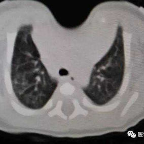 The CT scan shows the absence of the bone structure in the midline of the anterior chest wall
