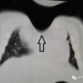 The CT scan shows a sternal defect