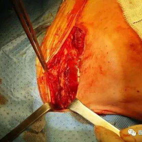 Left half of the sternal cleft