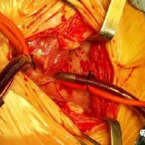 Intracardiac surgery performed with cardiopulmonary bypass support