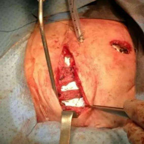 Three segments of the patient&rsquo;s own rib were placed parallelly at the site of the sternal defect