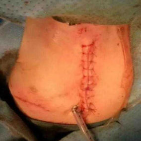 After the surgery, the abnormal breathing shown in the central region of the anterior chest wall disappeared, and there was no longer any depression during inhalation