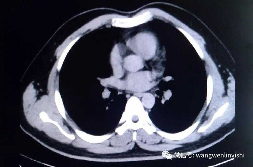 The CT scan shows the entire upper chest wall protrudes forward as a whole