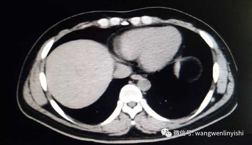 The CT scan shows the lower half of the chest wall is indented