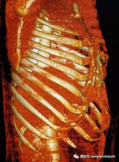 The 3D reconstruction displays a typical Wenlin chest contour