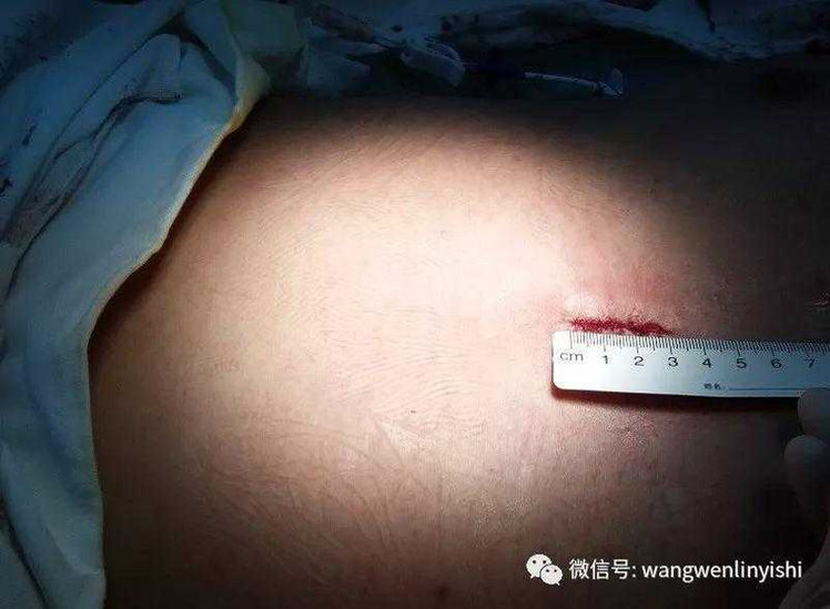 The 3 cm midline incision on the chest wall