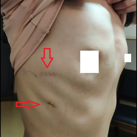 The anterior chest wall protrudes overall, featuring a central groove-shaped depression