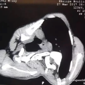 Preoperative CT scan