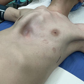 Preoperative chest wall appearance