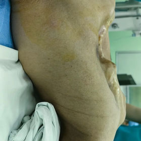 Preoperative appearance of the chest wall