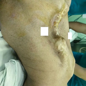 Preoperative appearance of the chest wall