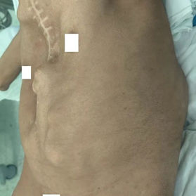 Preoperative appearance of the chest wall