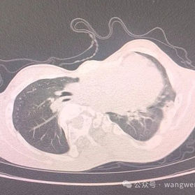 The anterior chest wall exhibits severe deformities, accompanied by scoliosis.