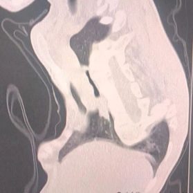 The anterior chest wall exhibits severe deformities.