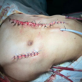 The postoperative appearance of the chest wall basically returned to normal.