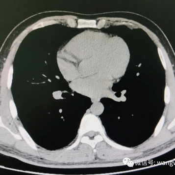 CT scan before the surgery