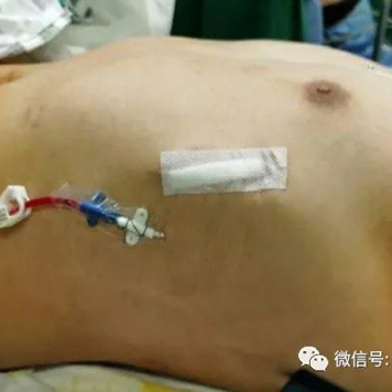 Chest wall appearance after the surgery