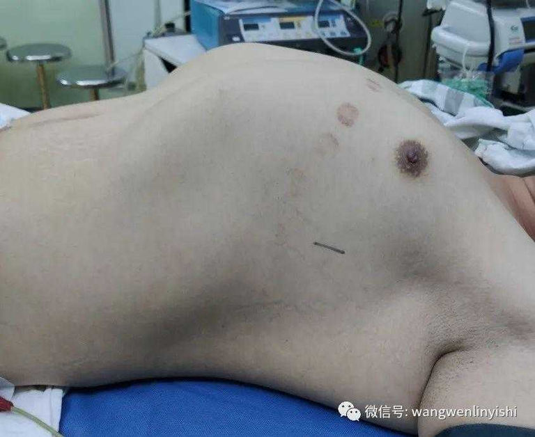 Severe barrel chest