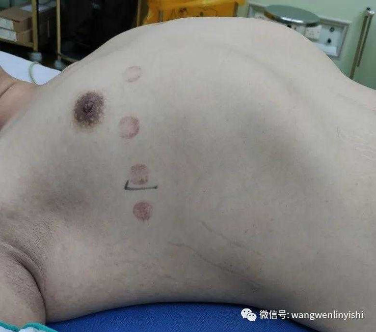 Severe protrusion of the entire chest wall, presenting a barrel-shaped appearance