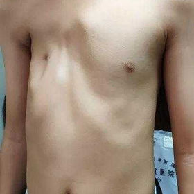 The chest wall appearance before the surgery