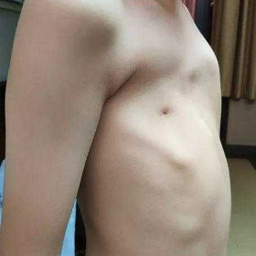 (The chest wall appearance before the surgery