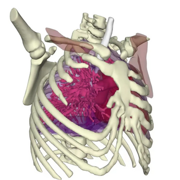 3D reconstruction image of the thorax before surgery