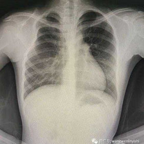 The X-ray shows underdevelopment of the right chest wall