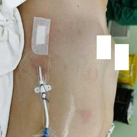 After the surgery, the chest wall appearance was essentially restored to normal, with the indentation on the right side eliminated