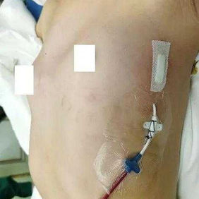 After the surgery, the chest wall appearance was essentially restored to normal, with the indentation on the right side eliminated