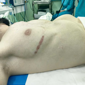 Severe deformity of the chest wall