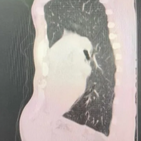 The anterior chest wall deforms severly, with clear compression on the heart