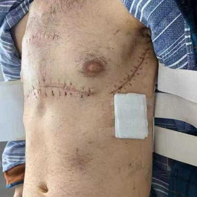 After surgery, the chest has returned to its normal size, and the narrowing has been eliminated