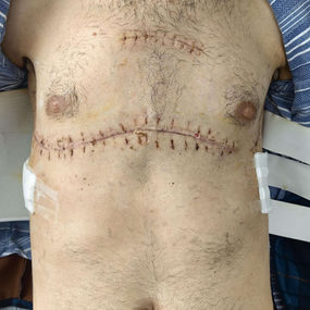 After surgery, the chest has returned to its normal size, and the narrowing has been eliminated