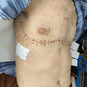 After surgery, the chest has returned to its normal size, and the narrowing has been eliminated