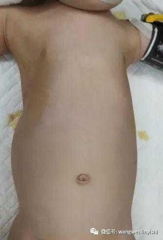 The overall anterior chest wall protrudes forward, with depressions on both sides.