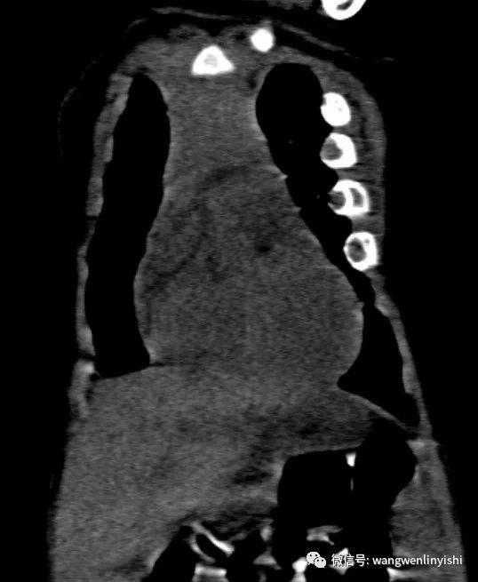 The CT image displaying a general narrowing of the thorax.