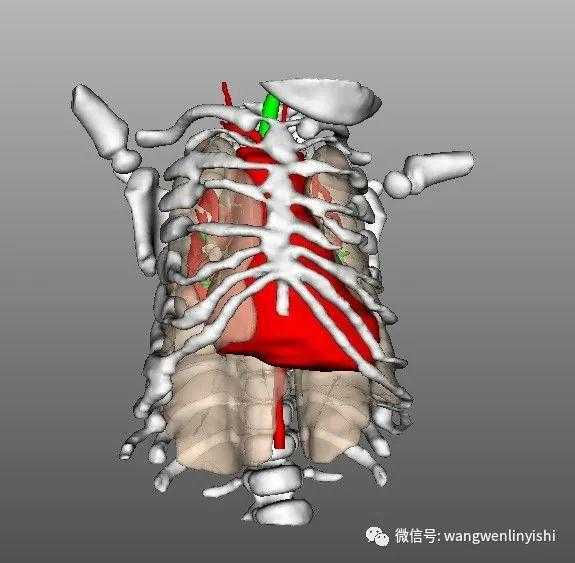The 3D reconstruction showing a general narrowing of the thoracic cage.