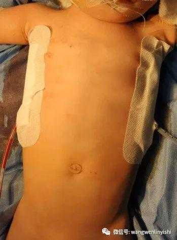 Postoperative image of the chest wall