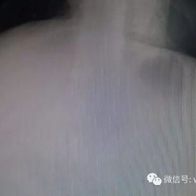 Both sides of the chest wall exhibit noticeable depressions.